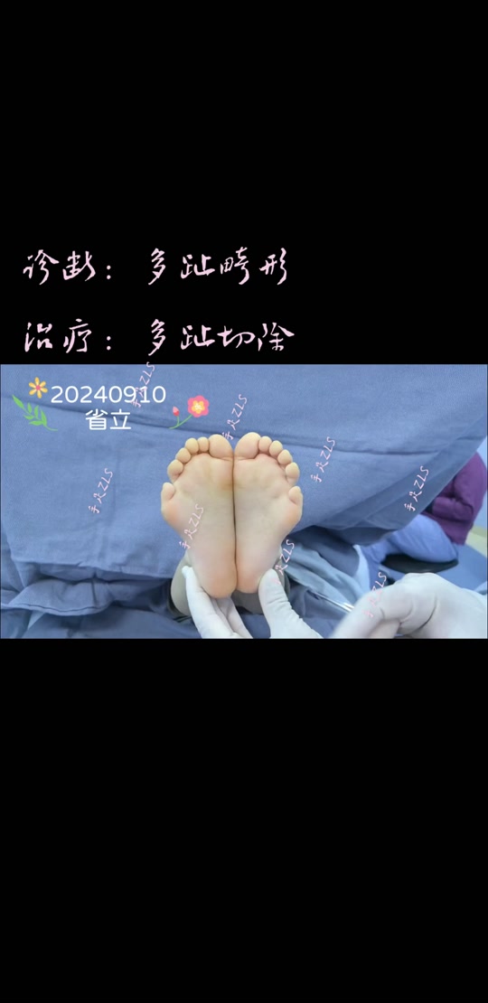 JJJ正式接受脚趾手术三个月后重新评估